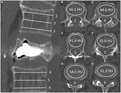 Evaluation of multidetector CT Hounsfield unit measurements as a predictor of efficacy and complications in percutaneous vertebroplasty for osteoporotic vertebral compression fractures